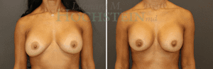 Breast Revision Patient