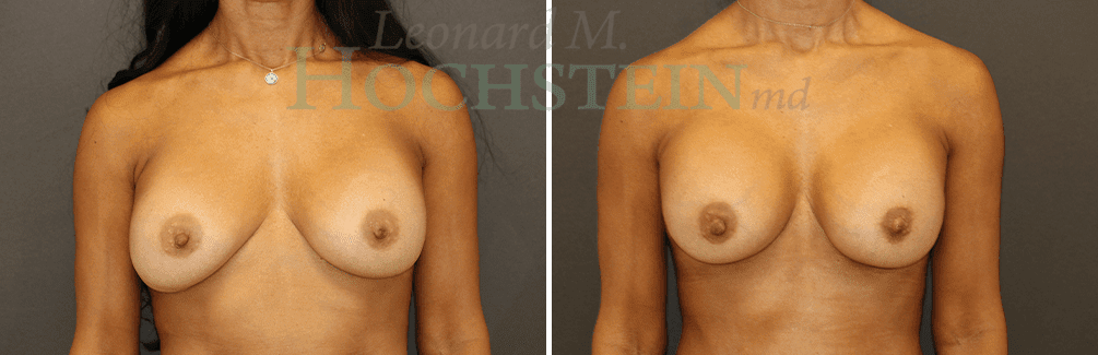 Breast Revision Patient