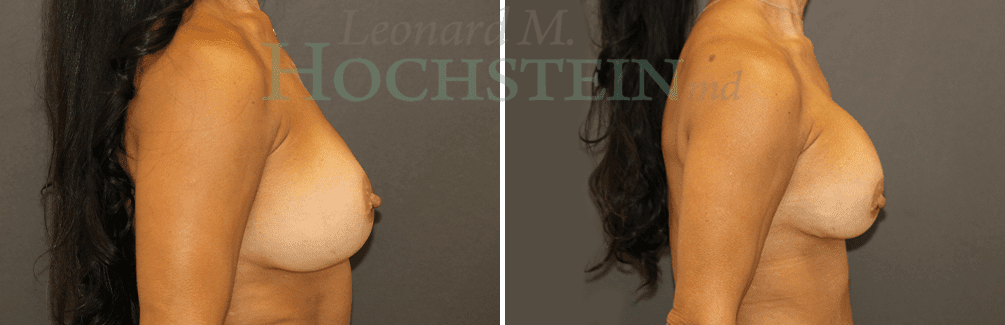 Breast Revision Patient