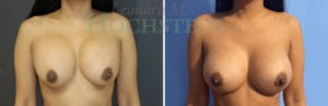 Breast Revision Patient 80