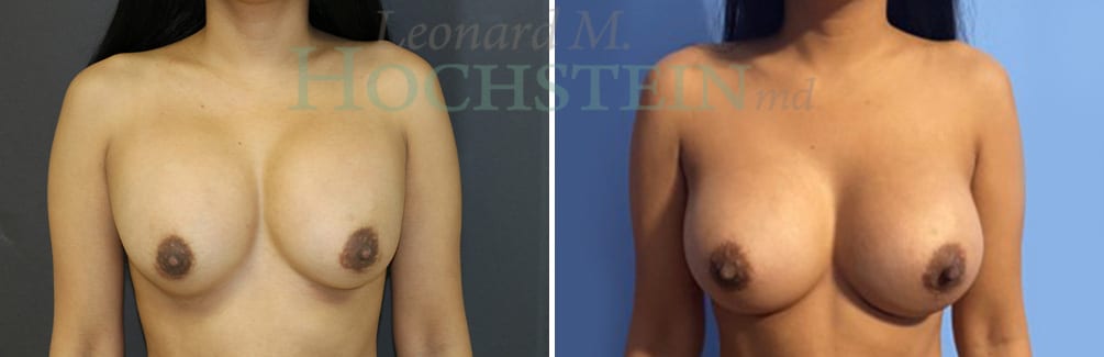 Breast Revision Patient