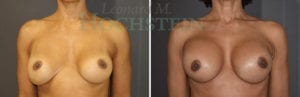 Breast Revision Patient