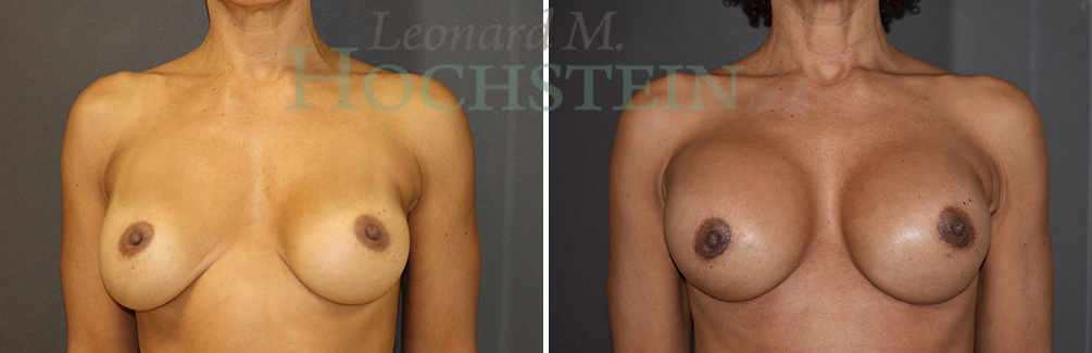 Breast Revision Patient