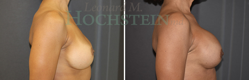 Breast Revision Patient