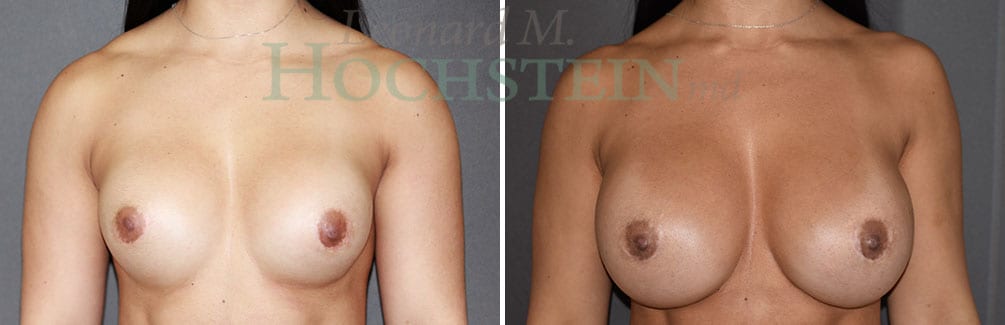 Breast Revision Patient