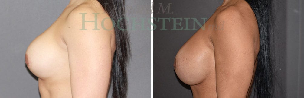Breast Revision Patient