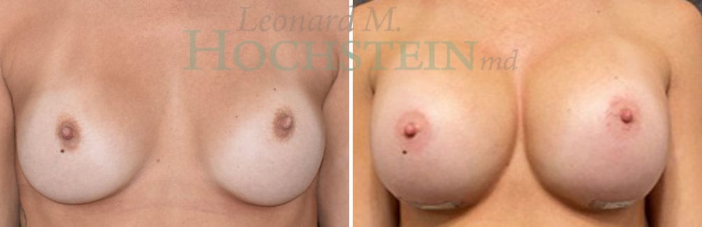 Breast Revision Patient