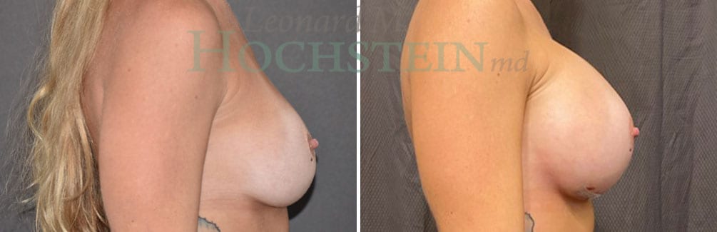 Breast Revision Patient