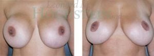 Breast Revision Patient