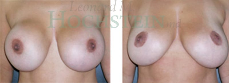 Breast Revision Patient