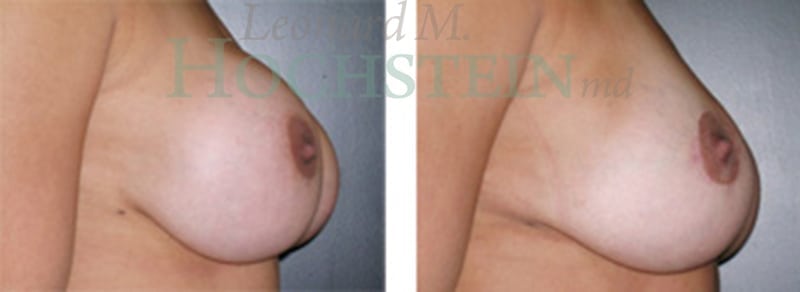Breast Revision Patient