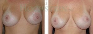 Breast Revision Patient