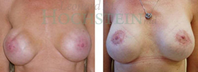 Breast Revision Patient