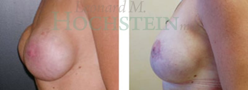 Breast Revision Patient