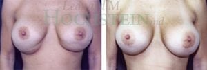 Breast Revision Patient 12