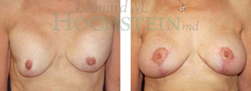 Breast Revision Patient