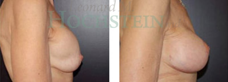 Breast Revision Patient