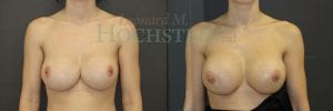 Breast Revision Patient