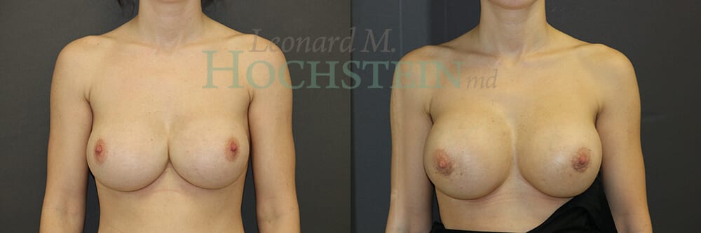 Breast Revision Patient