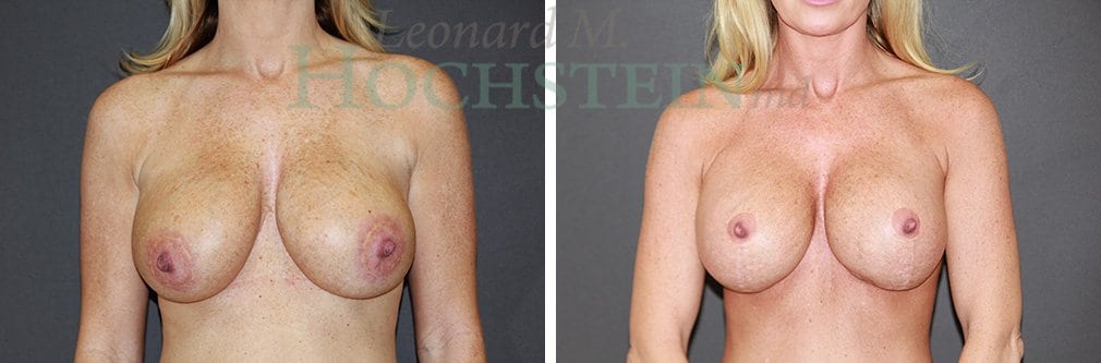 Breast Revision Patient