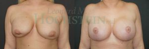 Breast Revision Patient 100