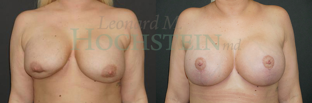 Breast Revision Patient