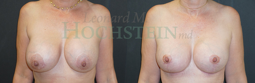 Breast Revision Patient