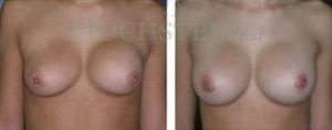 Breast Revision Patient