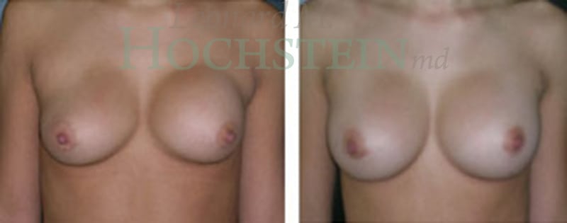Breast Revision Patient