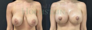 Breast Revision Patient 1189
