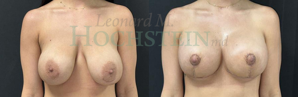 Breast Revision Patient