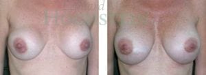 Breast Revision Patient 15