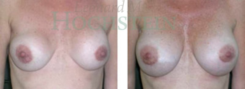 Breast Revision Patient