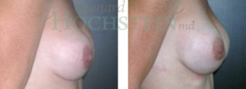 Breast Revision Patient