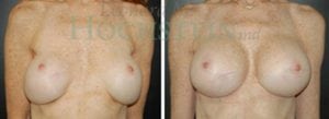 Breast Revision Patient