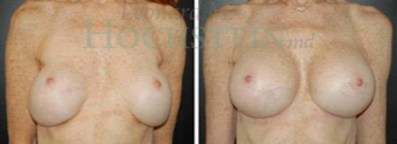Breast Revision Patient
