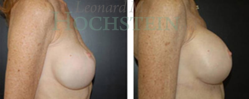 Breast Revision Patient