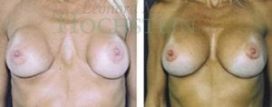 Breast Revision Patient 17
