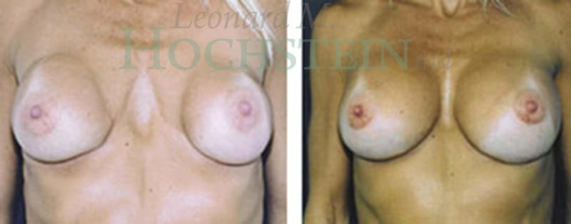 Breast Revision Patient