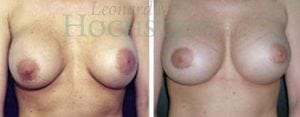 Breast Revision Patient 18