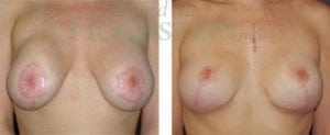Breast Revision Patient