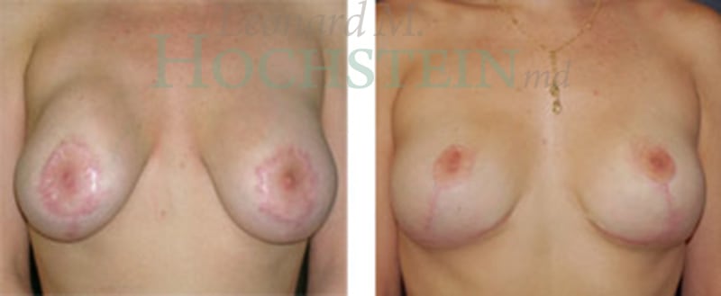 Breast Revision Patient