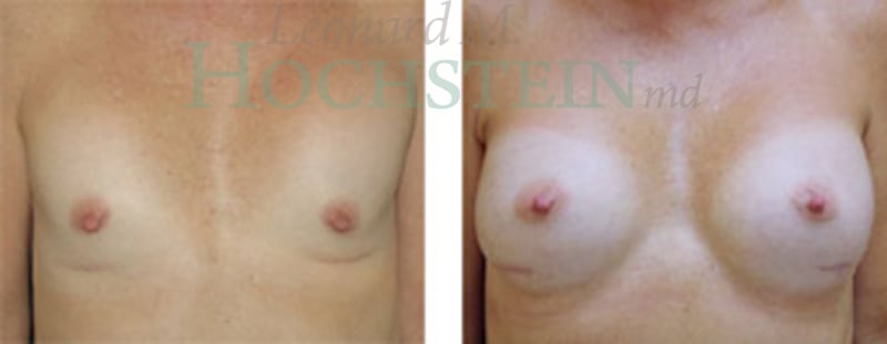 Breast Revision Patient