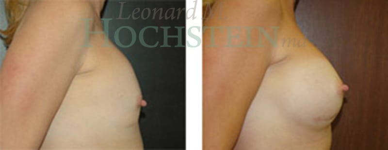 Breast Revision Patient