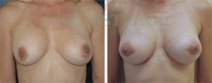 Breast Revision Patient