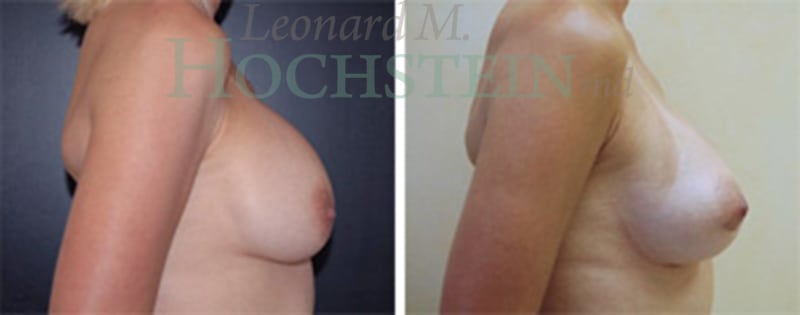 Breast Revision Patient