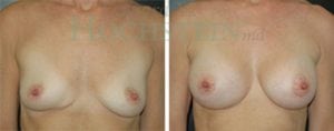 Breast Revision Patient