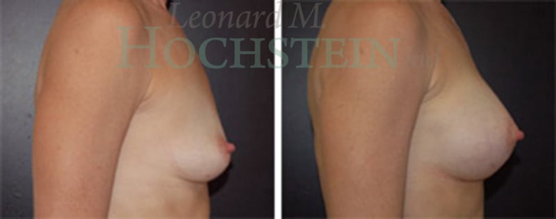 Breast Revision Patient