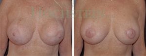 Breast Revision Patient
