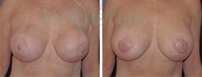 Breast Revision Patient